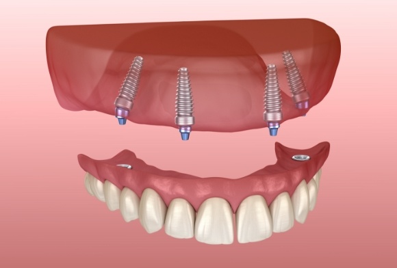 Animated all on four dental implant denture