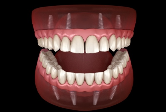 Animated smile with upper and lower all on four dental implant dentures