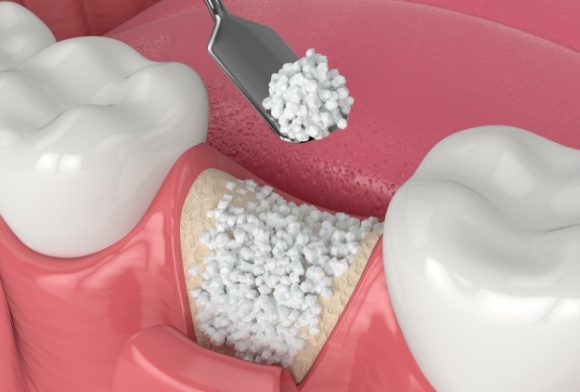 Animated smile during bone grafting procedure