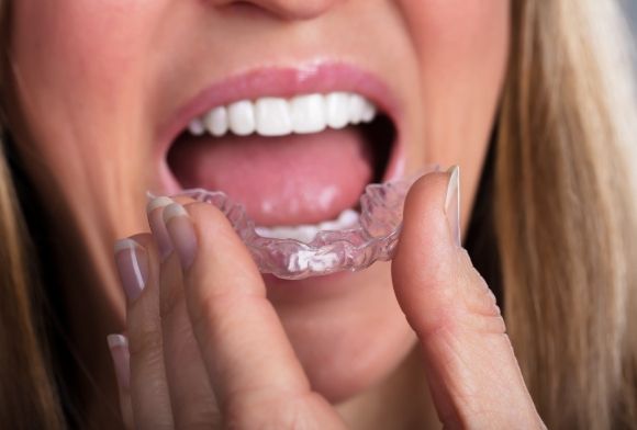 Patient placing mouthguard to treat dental bruxism