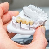 Dental bridge on a clay model