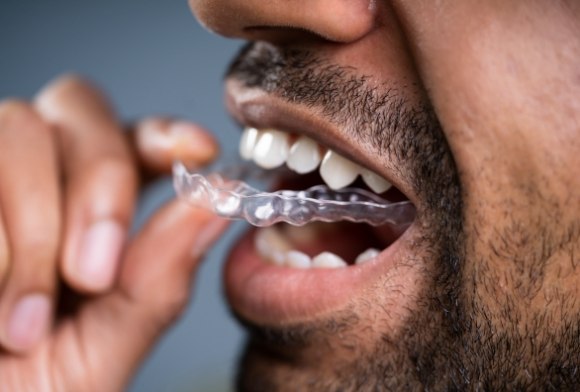 Man placing an Invisalign tray