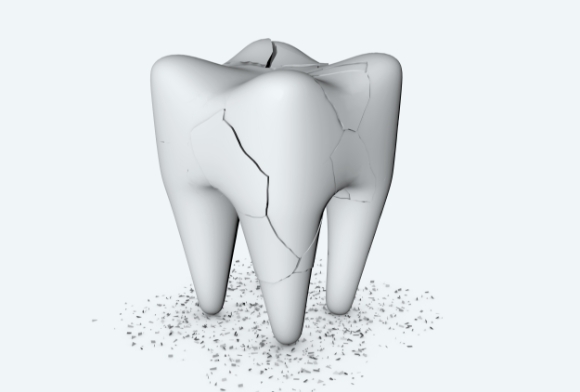 Animated tooth with cracked tooth syndrome