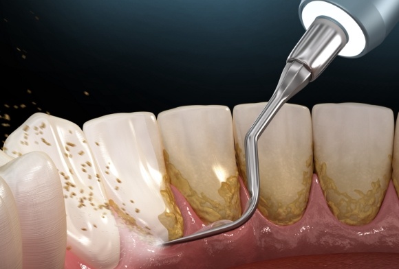 Animated smile during scaling and root planing deep cleaning for gum disease