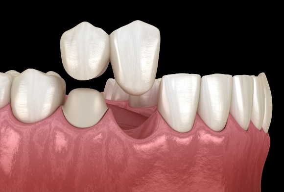 Animated smile during dental bridge placement