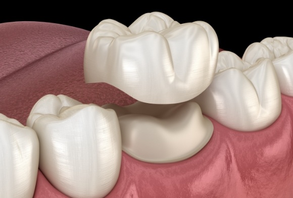 Animated smile during dental crown placement