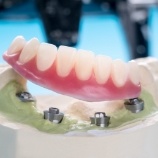 Model dental implant supported denture