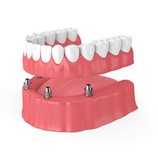 implant dentures illustration for cost of dentures in Carrollton 