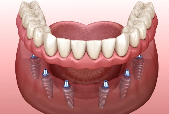 Denture resting on a model holding dental implants in Carrollton