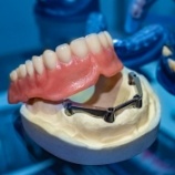 Model of dental implant denture
