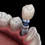 Animated smile during dental implant dental crown placement