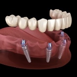 Animated smile during dental implant supported denture placement