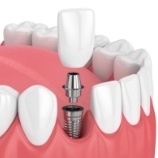 Animated smile showing parts of the dental implant