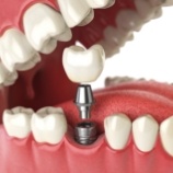 Animated smile during dental implant supported dental crown placement