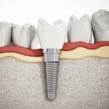 Smile with dental implant supported dental crown