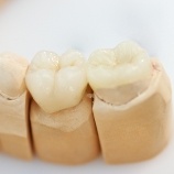 Model smile with dental implant restorations