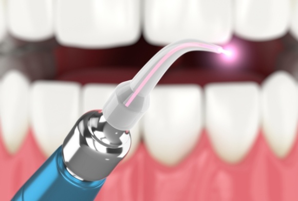 Animated smile and laser dentistry tool used for treatment after oral health diagnosis