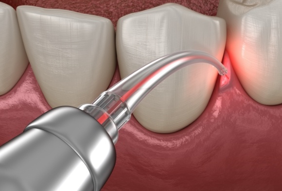 Animated smile during laser dentistry soft tissue procedure
