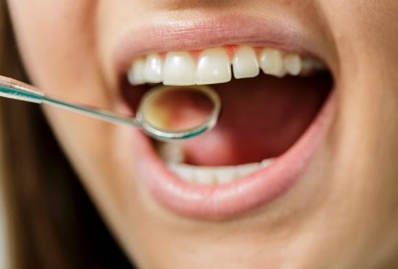 Closeup of patient receiving oral cancer screening