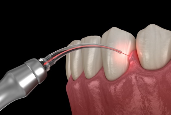 Animated smile during laser treatment