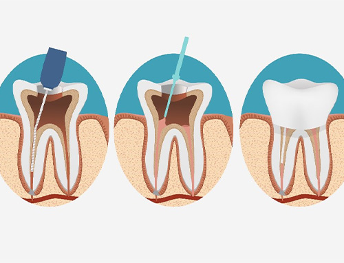 illistration for root canal therapy in Carrollton