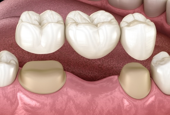 Animated smile during dental bridge placement