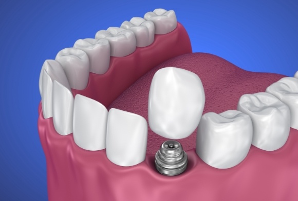 Animated smile during dental implant supported dental crown placement