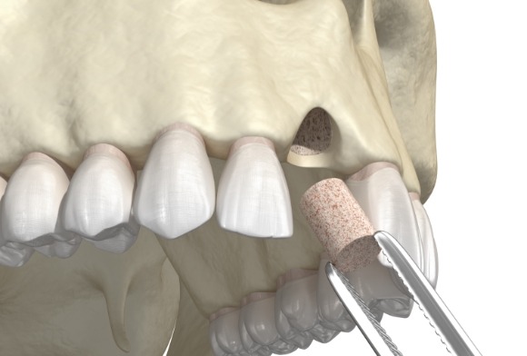Animated smile during bone grafting