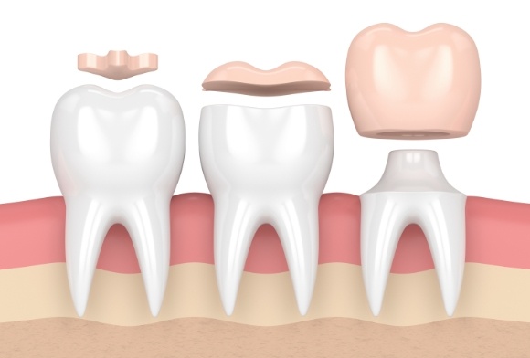 Animated teeth showing dental crowns compared to other dental restorations