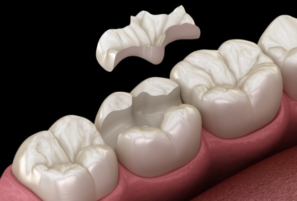 Animated smile during inlay placement