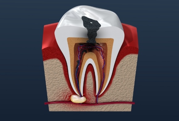 Animated tooth with decay and damage before root canal therapy
