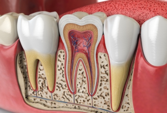Animated inside of tooth in need of root canal therapy