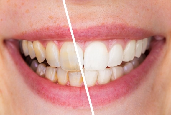 Smile before and after teeth whitening