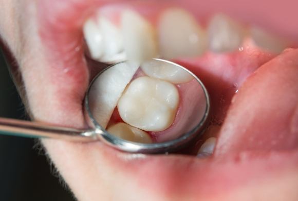 Dentist examining smile after tooth colored filling treatment