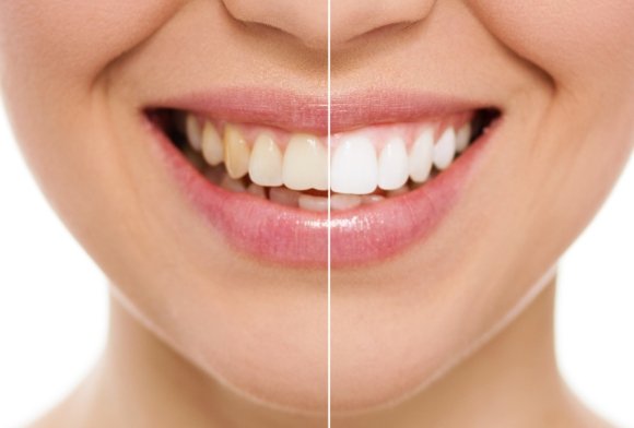 Smile before and after teeth whitening