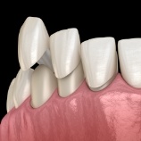 Animated smile during minimal prep veneers placement