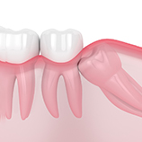 Render of an impacted wisdom tooth in Carrollton, TX