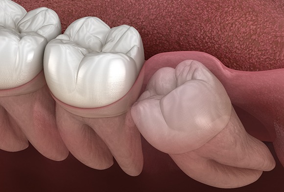 Wisdom teeth lurking below the surface