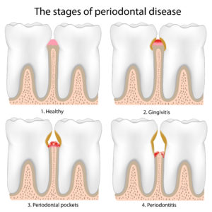 Illustration showing the stages of gum disease