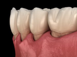 Digital image of gum recession