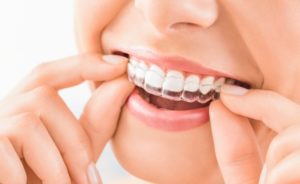 a closeup of an Invisalign aligner