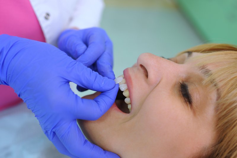 A dentist placing a woman’s veneers