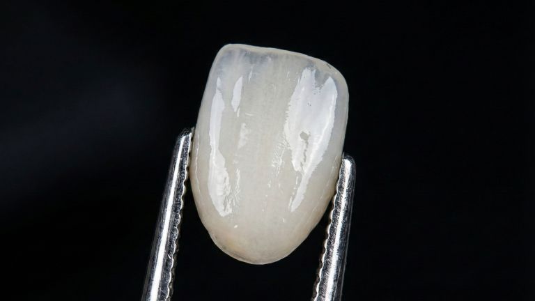 A porcelain veneer
